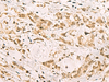 Immunohistochemistry of paraffin-embedded Human gastric cancer tissue  using PDS5A Polyclonal Antibody at dilution of 1:90(×200)