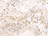 Immunohistochemistry of paraffin-embedded Human lung cancer tissue  using PDS5A Polyclonal Antibody at dilution of 1:90(×200)