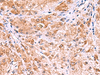Immunohistochemistry of paraffin-embedded Human liver cancer tissue  using UXS1 Polyclonal Antibody at dilution of 1:60(×200)