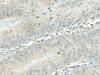 Immunohistochemistry of paraffin-embedded Human colorectal cancer tissue  using DENND6A Polyclonal Antibody at dilution of 1:120(×200)