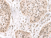 Immunohistochemistry of paraffin-embedded Human esophagus cancer tissue  using ERH Polyclonal Antibody at dilution of 1:55(×200)