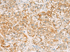 Immunohistochemistry of paraffin-embedded Human liver cancer tissue  using SH3YL1 Polyclonal Antibody at dilution of 1:55(×200)