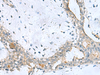 Immunohistochemistry of paraffin-embedded Human breast cancer tissue  using PPIC Polyclonal Antibody at dilution of 1:50(×200)