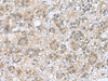 Immunohistochemistry of paraffin-embedded Human liver cancer tissue  using RAB39A Polyclonal Antibody at dilution of 1:70(×200)