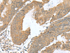 Immunohistochemistry of paraffin-embedded Human colorectal cancer tissue  using RAB23 Polyclonal Antibody at dilution of 1:50(×200)