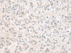 Immunohistochemistry of paraffin-embedded Human liver cancer tissue  using ANKS6 Polyclonal Antibody at dilution of 1:55(×200)