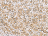 Immunohistochemistry of paraffin-embedded Human liver cancer tissue  using LFNG Polyclonal Antibody at dilution of 1:60(×200)