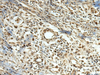 Immunohistochemistry of paraffin-embedded Human breast cancer tissue  using MLF1 Polyclonal Antibody at dilution of 1:105(×200)