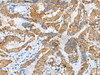 Immunohistochemistry of paraffin-embedded Human thyroid cancer tissue  using FBXO8 Polyclonal Antibody at dilution of 1:40(×200)