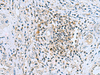 Immunohistochemistry of paraffin-embedded Human liver cancer tissue  using DHRS7B Polyclonal Antibody at dilution of 1:80(×200)