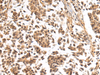 Immunohistochemistry of paraffin-embedded Human breast cancer tissue  using NHLRC2 Polyclonal Antibody at dilution of 1:40(×200)