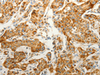 Immunohistochemistry of paraffin-embedded Human lung cancer tissue  using VDAC2 Polyclonal Antibody at dilution of 1:25(×200)