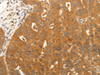 Immunohistochemistry of paraffin-embedded Human ovarian cancer tissue  using CDH5 Polyclonal Antibody at dilution of 1:30(×200)