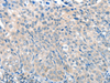 Immunohistochemistry of paraffin-embedded Human cervical cancer tissue  using SLC17A6 Polyclonal Antibody at dilution of 1:100(×200)
