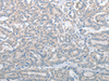 Immunohistochemistry of paraffin-embedded Human thyroid cancer tissue  using SLC17A6 Polyclonal Antibody at dilution of 1:100(×200)