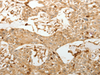 Immunohistochemistry of paraffin-embedded Human esophagus cancer tissue  using VMA21 Polyclonal Antibody at dilution of 1:150(×200)