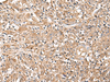 Immunohistochemistry of paraffin-embedded Human liver cancer tissue  using LEPR Polyclonal Antibody at dilution of 1:30(×200)