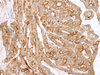 Immunohistochemistry of paraffin-embedded Human thyroid cancer tissue  using MCAM Polyclonal Antibody at dilution of 1:40(×200)