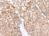 Immunohistochemistry of paraffin-embedded Human ovarian cancer tissue  using MCAM Polyclonal Antibody at dilution of 1:40(×200)