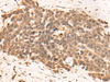 Immunohistochemistry of paraffin-embedded Human thyroid cancer tissue  using CLK2 Polyclonal Antibody at dilution of 1:45(×200)