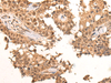 Immunohistochemistry of paraffin-embedded Human ovarian cancer tissue  using CLK2 Polyclonal Antibody at dilution of 1:45(×200)