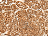 Immunohistochemistry of paraffin-embedded Human esophagus cancer tissue  using NEK7 Polyclonal Antibody at dilution of 1:60(×200)