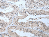 Immunohistochemistry of paraffin-embedded Human liver cancer tissue  using TBX1 Polyclonal Antibody at dilution of 1:40(×200)