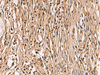 Immunohistochemistry of paraffin-embedded Human colorectal cancer tissue  using ENTPD1 Polyclonal Antibody at dilution of 1:60(×200)