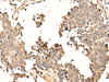 Immunohistochemistry of paraffin-embedded Human lung cancer tissue  using SOX3 Polyclonal Antibody at dilution of 1:50(×200)