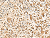 Immunohistochemistry of paraffin-embedded Human prost ate cancer tissue  using SOX3 Polyclonal Antibody at dilution of 1:50(×200)