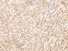 Immunohistochemistry of paraffin-embedded Human gastric cancer tissue  using MYCT1 Polyclonal Antibody at dilution of 1:35(×200)