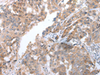 Immunohistochemistry of paraffin-embedded Human breast cancer tissue  using COX7C Polyclonal Antibody at dilution of 1:40(×200)