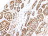 Immunohistochemistry of paraffin-embedded Human esophagus cancer tissue  using FOXG1  Polyclonal Antibody at dilution of 1:60(×200)