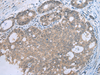 Immunohistochemistry of paraffin-embedded Human gastric cancer tissue  using CCNG1 Polyclonal Antibody at dilution of 1:30(×200)