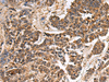 Immunohistochemistry of paraffin-embedded Human colorectal cancer tissue  using GANAB Polyclonal Antibody at dilution of 1:30(×200)