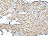 Immunohistochemistry of paraffin-embedded Human ovarian cancer tissue  using MEF2D Polyclonal Antibody at dilution of 1:50(×200)