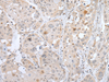 Immunohistochemistry of paraffin-embedded Human esophagus cancer tissue  using BORCS8 Polyclonal Antibody at dilution of 1:50(×200)
