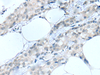 Immunohistochemistry of paraffin-embedded Human breast cancer tissue  using MOG Polyclonal Antibody at dilution of 1:25(×200)