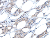 Immunohistochemistry of paraffin-embedded Human breast cancer tissue  using ANGPTL6 Polyclonal Antibody at dilution of 1:55(×200)