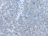 Immunohistochemistry of paraffin-embedded Human liver cancer tissue  using NF1 Polyclonal Antibody at dilution of 1:65(×200)