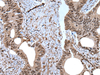 Immunohistochemistry of paraffin-embedded Human colorectal cancer tissue  using ZNF787 Polyclonal Antibody at dilution of 1:45(×200)