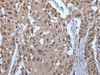 Immunohistochemistry of paraffin-embedded Human esophagus cancer tissue  using ZNF787 Polyclonal Antibody at dilution of 1:45(×200)