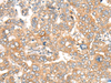 Immunohistochemistry of paraffin-embedded Human liver cancer tissue  using CASP4 Polyclonal Antibody at dilution of 1:40(×200)