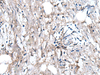 Immunohistochemistry of paraffin-embedded Human gastric cancer tissue  using WRN Polyclonal Antibody at dilution of 1:55(×200)