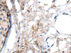 Immunohistochemistry of paraffin-embedded Human breast cancer tissue  using WRN Polyclonal Antibody at dilution of 1:55(×200)