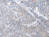Immunohistochemistry of paraffin-embedded Human liver cancer tissue  using WIF1 Polyclonal Antibody at dilution of 1:100(×200)