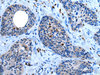Immunohistochemistry of paraffin-embedded Human cervical cancer tissue  using WISP2 Polyclonal Antibody at dilution of 1:45(×200)