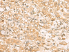 Immunohistochemistry of paraffin-embedded Human liver cancer tissue  using USP24 Polyclonal Antibody at dilution of 1:35(×200)
