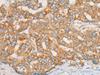 Immunohistochemistry of paraffin-embedded Human liver cancer tissue  using ATXN7 Polyclonal Antibody at dilution of 1:60(×200)