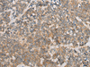 Immunohistochemistry of paraffin-embedded Human lung cancer tissue  using ATXN7 Polyclonal Antibody at dilution of 1:60(×200)